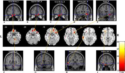 Patterns of Gray and White Matter Volume Alterations in Patients With Post-Traumatic Anosmia: A Voxel-Based Morphometry Study